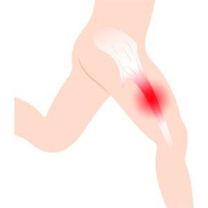 תסמונת Iliotibial band syndrome לספורטאים